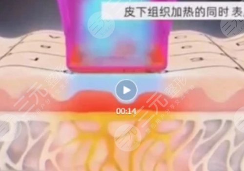 热玛吉有什么效果和副作用有哪些？