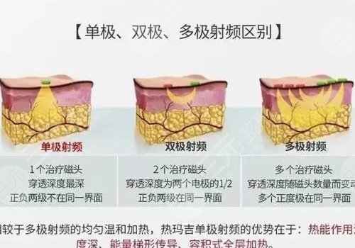 热玛吉有什么效果和副作用有哪些？