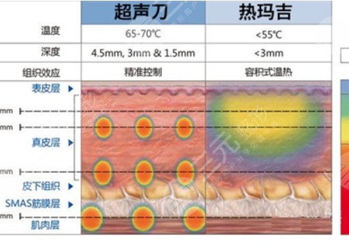 热玛吉有什么效果和副作用有哪些？