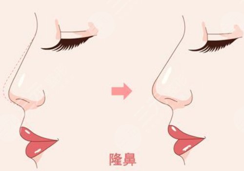 濡白天使隆鼻维持多久？