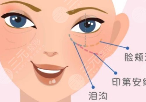 双美胶原蛋白填充泪沟能维持多久?