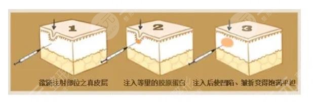 双美胶原蛋白填充泪沟能维持多久?