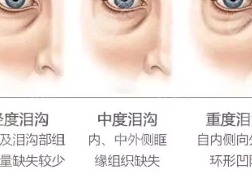 双美胶原蛋白填充泪沟能维持多久?