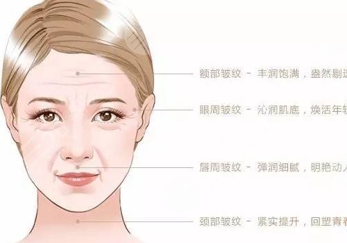 公主玻尿酸适合打哪里?