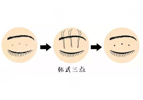 双眼皮手术有几种做法?