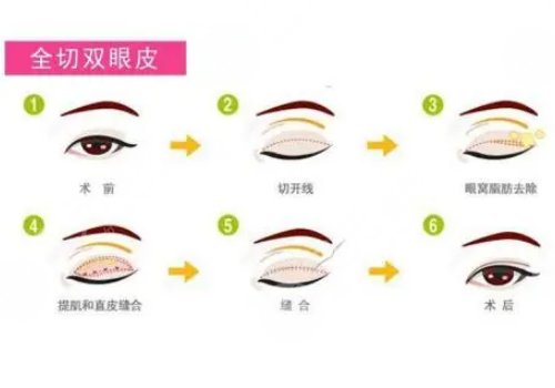 双眼皮手术有几种做法?
