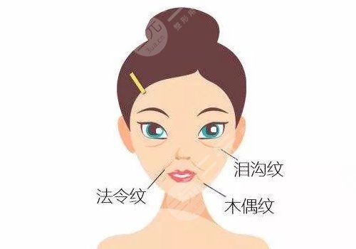 玻尿酸填充法令纹多久可以恢复自然?