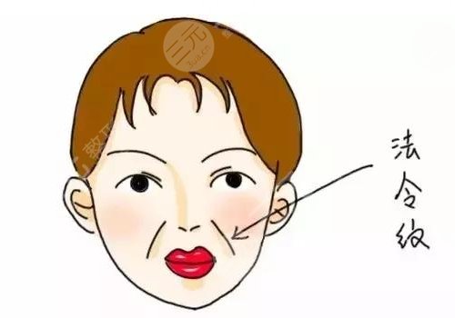 玻尿酸填充法令纹的注意事项有哪些
