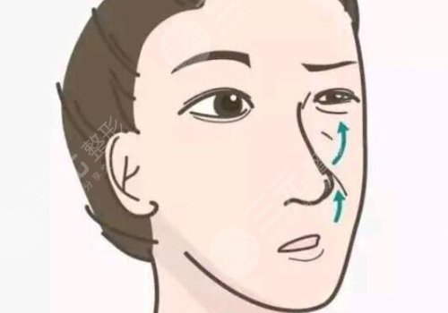 玻尿酸填充法令纹的注意事项有哪些