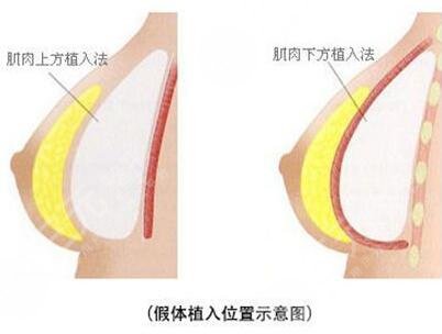 做了假体隆胸手术之后需要注意什么?