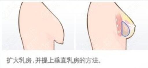 乳房悬吊术多久可以恢复?
