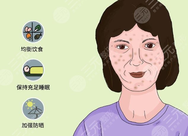 激光治疗黄褐斑原理是什么?