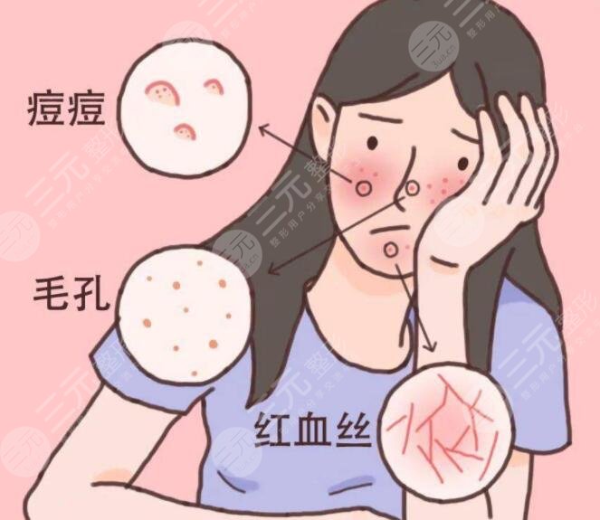 治疗脸部红血丝的方法有哪些?