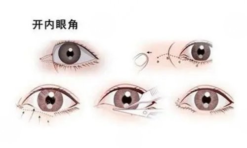 影响开内眼角手术价格的因素有哪些?