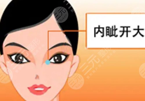 影响开内眼角手术价格的因素有哪些?
