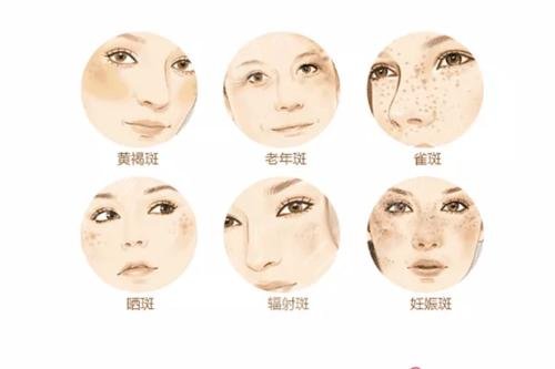 黄褐斑什么时候?治疗好?