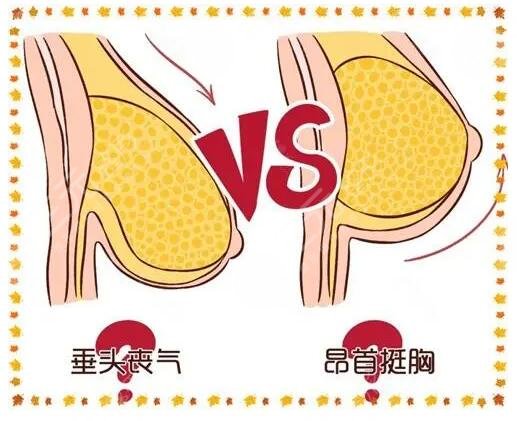 下垂胸怎么矫正效果好?