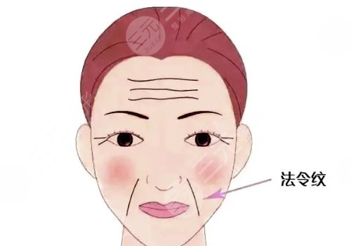 法令纹填充用什么方法好?