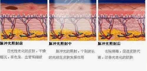 光子嫩肤去雀斑的注意事项