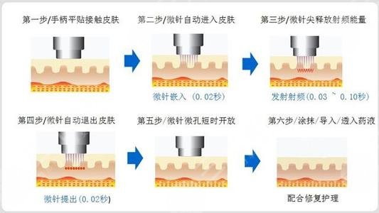 收缩毛孔的医美项目有哪些?
