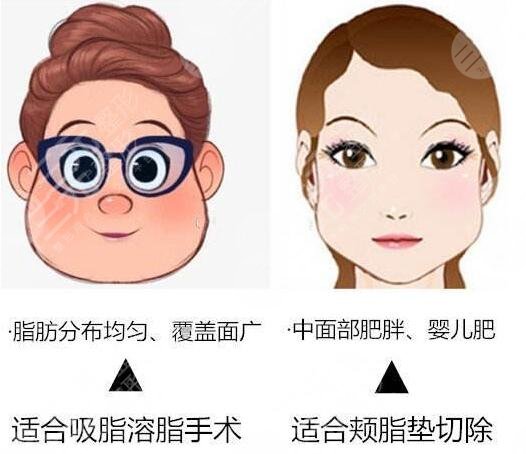 去颊脂垫后遗症可能有哪些?