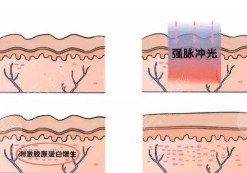 激光美容去疤痕效果怎么样?