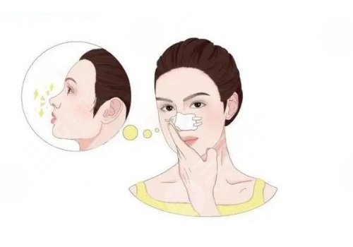 整鼻子鼻翼缩小多少钱？有后遗症吗？