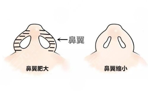 整鼻子鼻翼缩小多少钱？有后遗症吗？