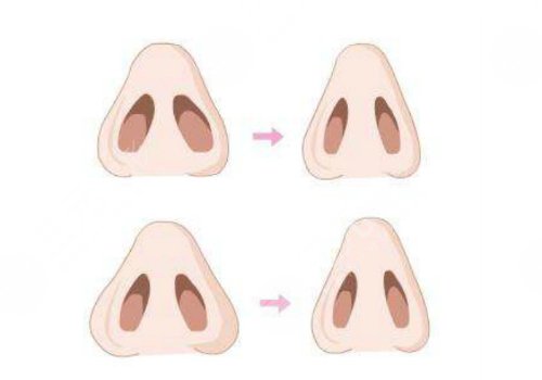 整鼻子鼻翼缩小多少钱？有后遗症吗？
