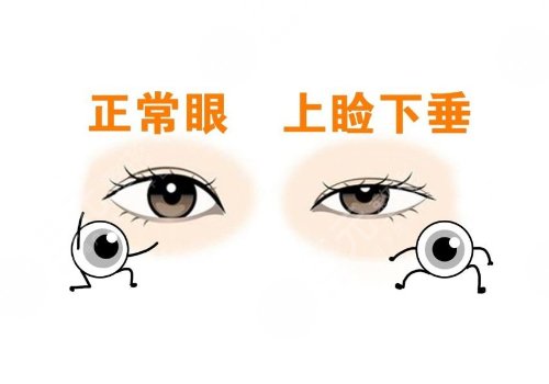上睑下垂矫正大概需要多少费用?