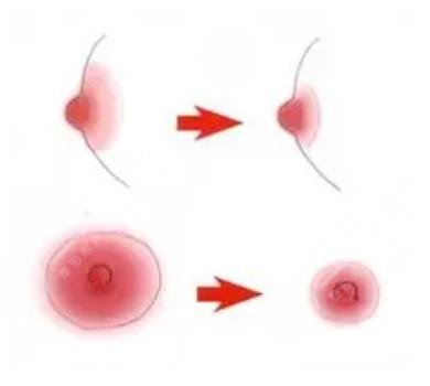 乳晕大