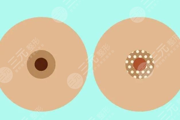 乳晕大
