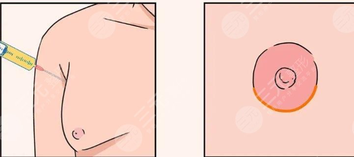 乳晕大