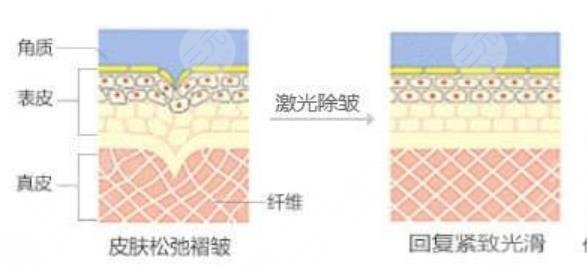 激光除皱
