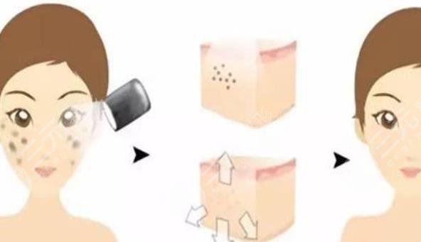 激光嫩肤