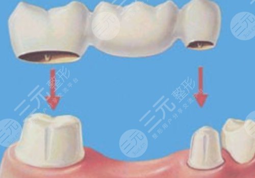 门牙烤瓷牙多少钱一颗牙齿？