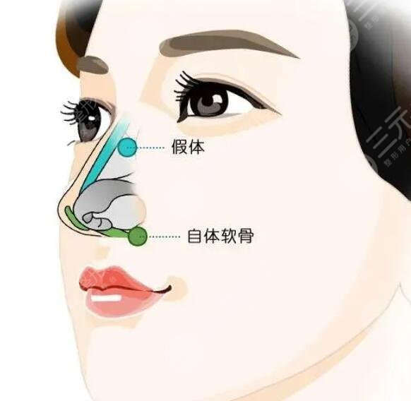 硅胶隆鼻手术的原理是什么?
