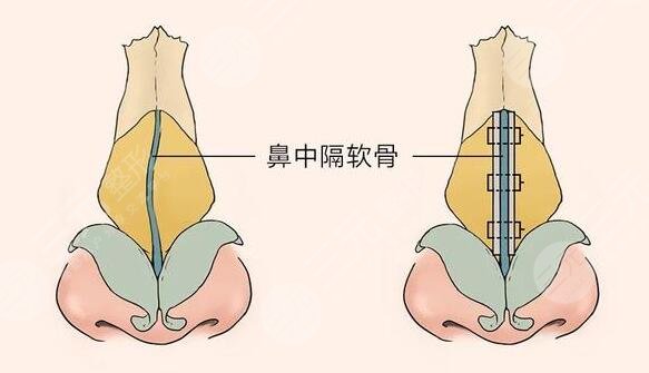 歪鼻矫正的手术功效