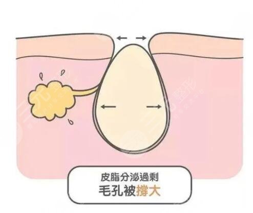 男性毛孔粗大怎么办?
