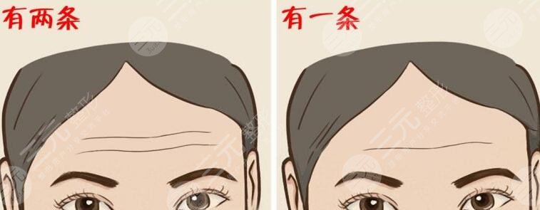 抬头纹是什么?