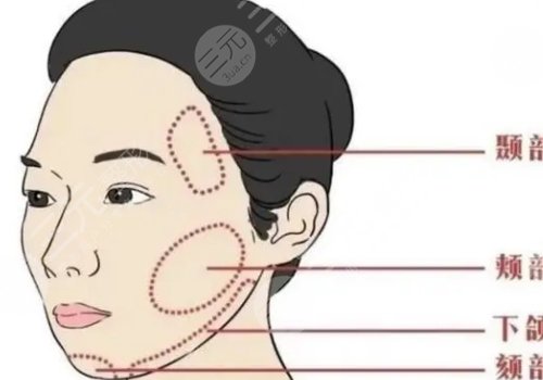 脸部填充用什么填充好?能维持多久?