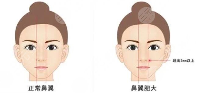 缩鼻翼手术原理