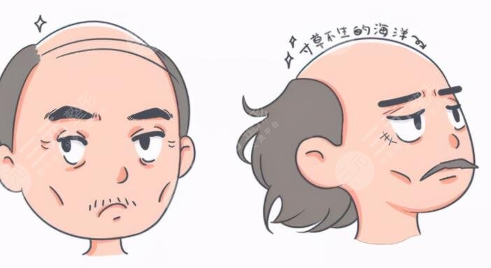 生姜能治疗脱发吗？怎么正确使用不伤头皮？详细操作方法告诉你！