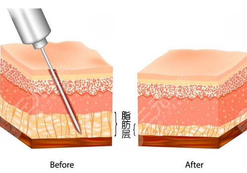 腹部抽脂术后需要修复几天才能恢复？