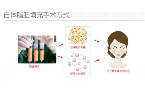 自体脂肪填充下眼睑凹陷可以维持多久？