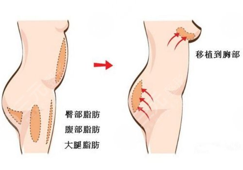 自体脂肪隆胸可以保持多少年？