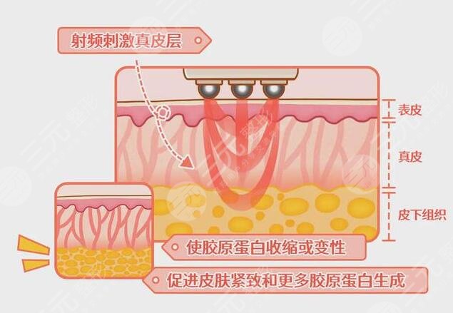热玛吉是什么原理?