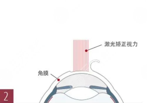近视眼手术价格是多少？
