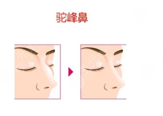 驼峰鼻矫正术手术多少钱??