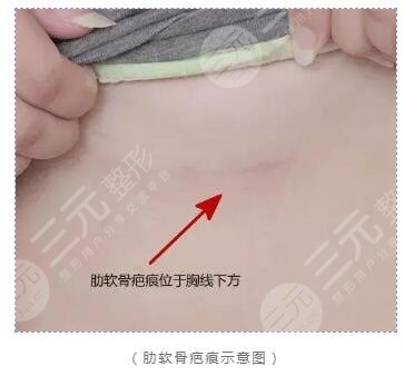 肋软骨隆鼻的优势是什么?